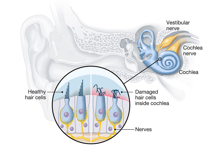 Hearing loss hearing related